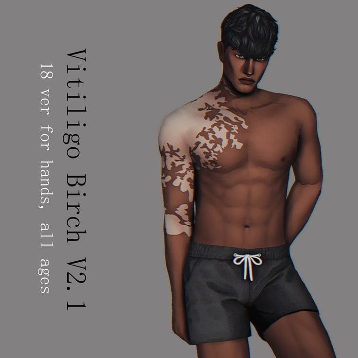 sims 4 vitiligo cc